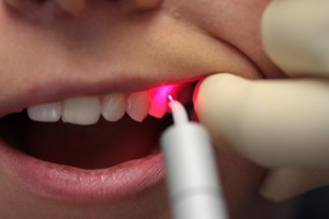 Лечение зубов лазером - хирургия