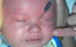 Зондирование глаза у новорожденного