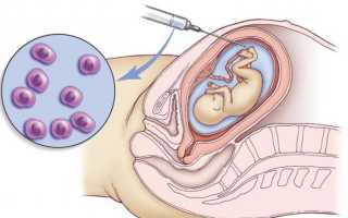 Признаки синдрома Дауна у плода в период беременности