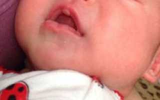 Мозоль на губе у младенцев