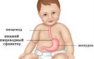 Гастроэзофагеальный рефлюкс у новорожденных