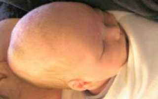 Почему возникает гематома на голове у младенца и опасна ли она