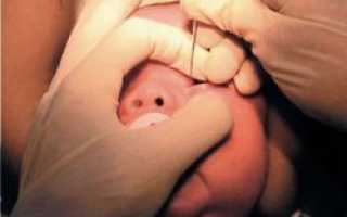 Зондирование глаз у новорожденных