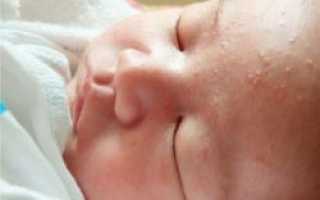 Гормональная сыпь у новорожденных