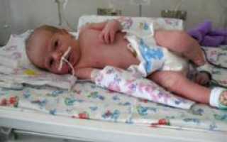 Что такое асфиксия у новорожденных и как ее лечить
