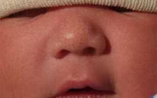 Белые точки на носике у новорожденного