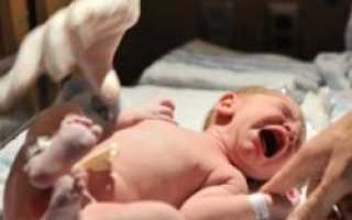 Родовые травмы у новорожденных