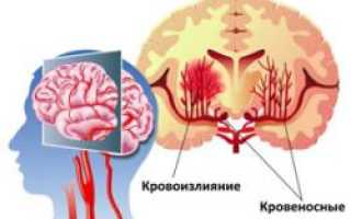 Кровоизлияние в мозг у новорожденного