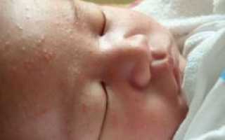 Сыпи у новорожденных