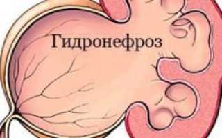 Гидронефроз (расширение лоханки) у новорожденных