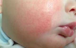 Аллергия на смесь у грудничков