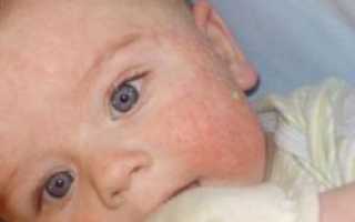Капли против аллергии для новорожденных