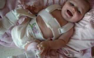 Дисплазия тазобедренных суставов у младенцев