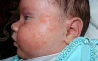Как проявляется аллергия у новорожденных и как ее лечить?