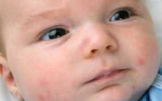 Основные причины сыпи на лице у младенца