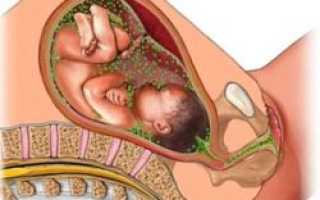 Внутриутробные инфекции у новорожденных