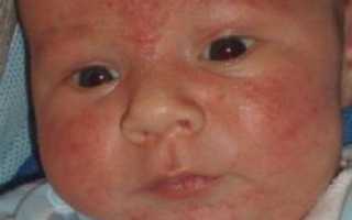 Как проявляется аллергия у новорожденных